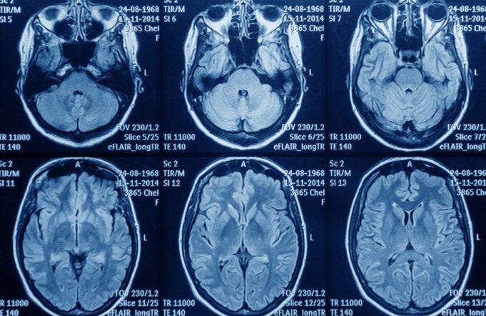 Astuce critica la falta de equidad en el acceso a TTFields para tratar el glioblastoma en España