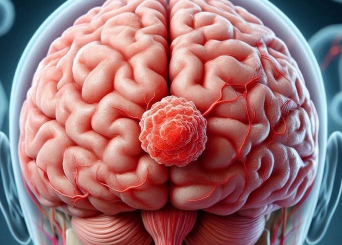 Astuce Spain pide ensayos clínicos y equidad en tumores cerebrales para fomentar tratamientos innovadores