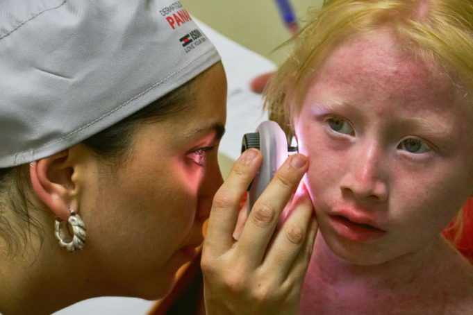 Isdin realiza campaña en Panamá para prevenir el cáncer de piel en personas con albinismo