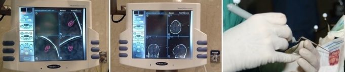 Avances en neuronavegación mejoran el tratamiento de tumores cerebrales y columna
