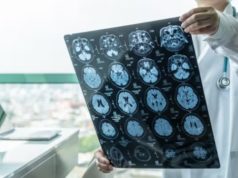 ASTUCE Spain pide incluir el oligodendroglioma en el registro de enfermedades raras