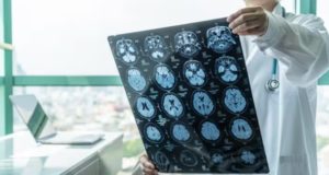ASTUCE Spain pide incluir el oligodendroglioma en el registro de enfermedades raras