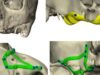 La cirugía oral avanza con implantes subperiósticos diseñados mediante tecnología CAD/CAM