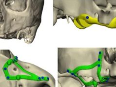 La cirugía oral avanza con implantes subperiósticos diseñados mediante tecnología CAD/CAM