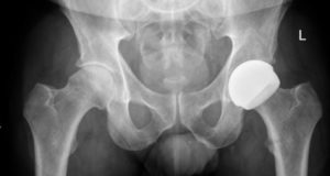Las prótesis resurfacing amplían las posibilidades para pacientes activos