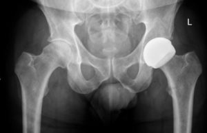 Las prótesis resurfacing amplían las posibilidades para pacientes activos